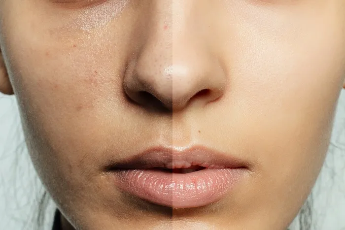 Peeling