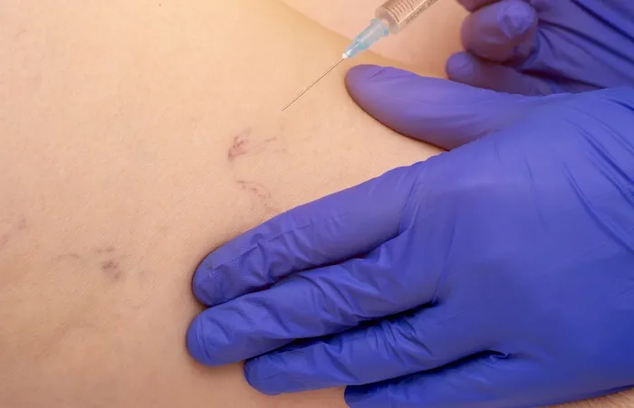 Scleroterapia di capillari