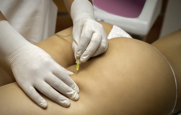 carboxytherapy-body