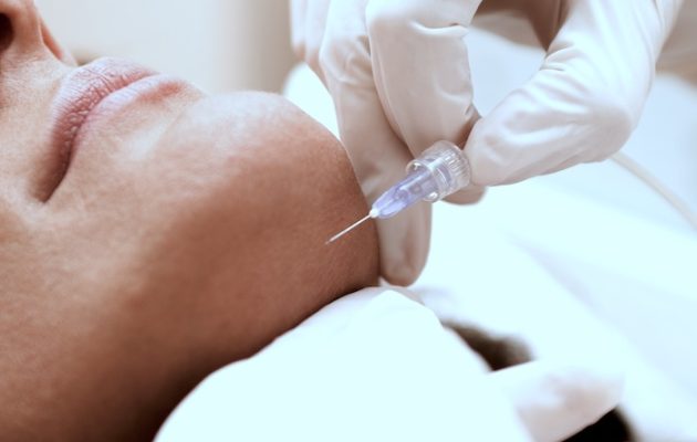 carboxytherapy-face