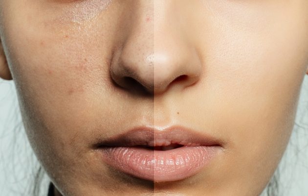 face-peeling