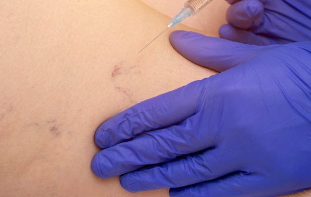sclerotherapy-body
